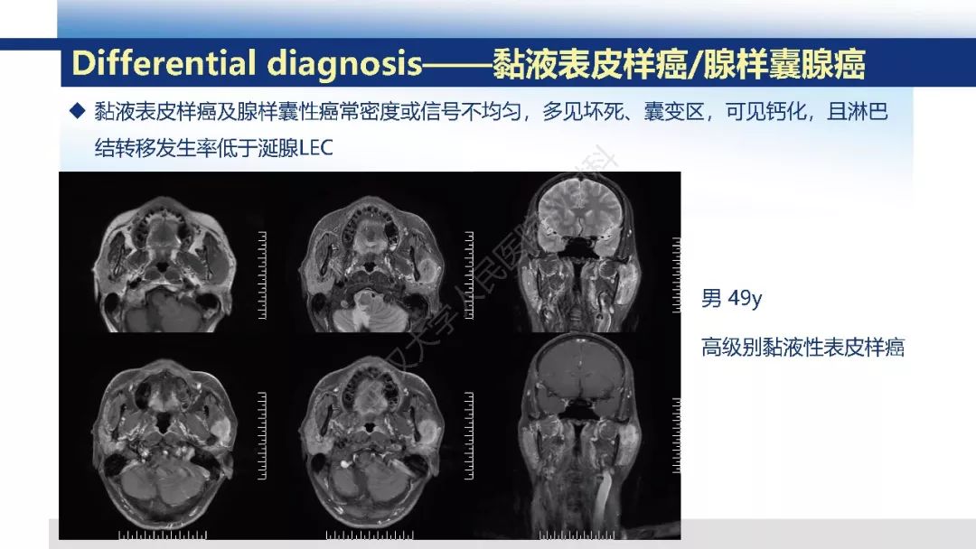 【PPT】涎腺淋巴上皮癌影像诊断