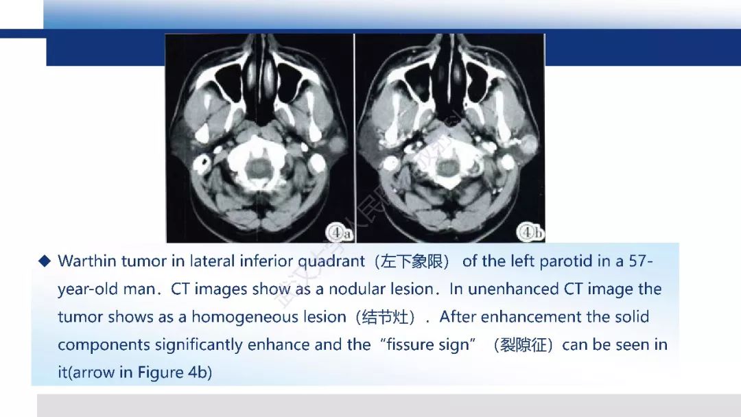 【PPT】涎腺淋巴上皮癌影像诊断