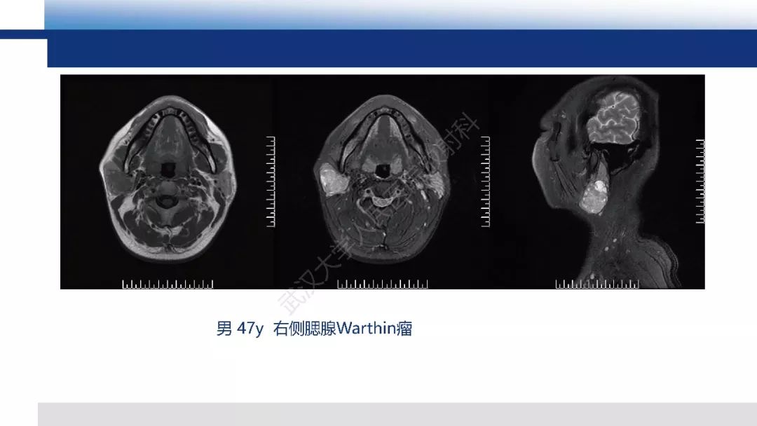 【PPT】涎腺淋巴上皮癌影像诊断