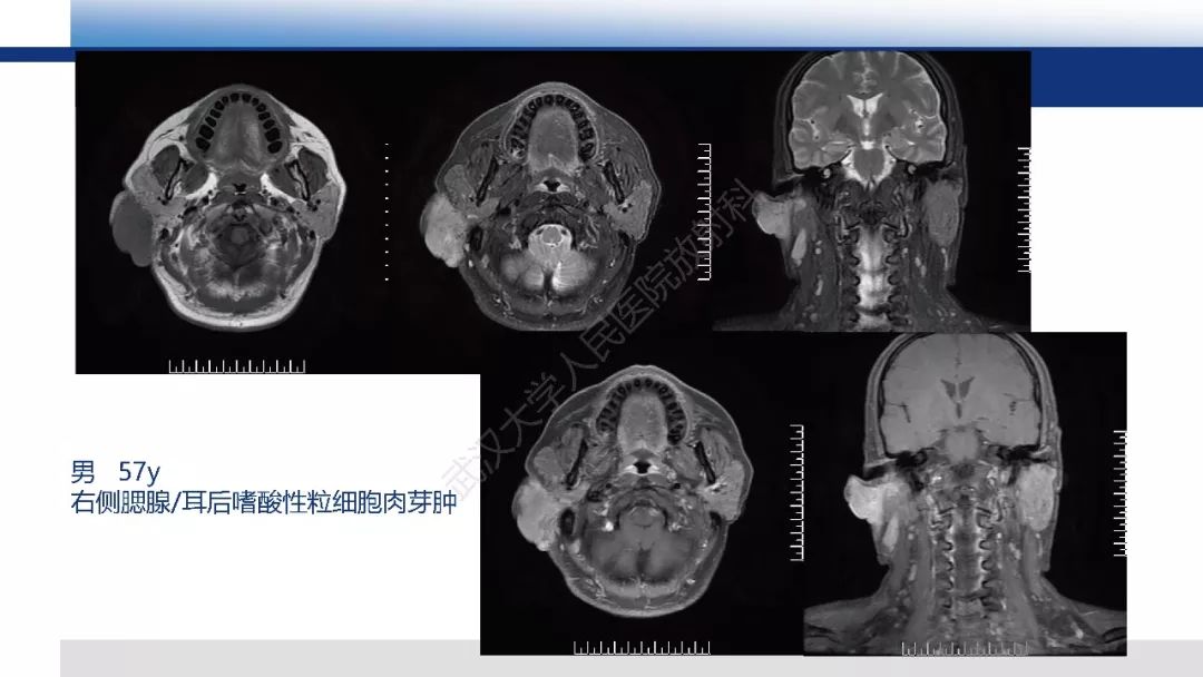 【PPT】涎腺淋巴上皮癌影像诊断