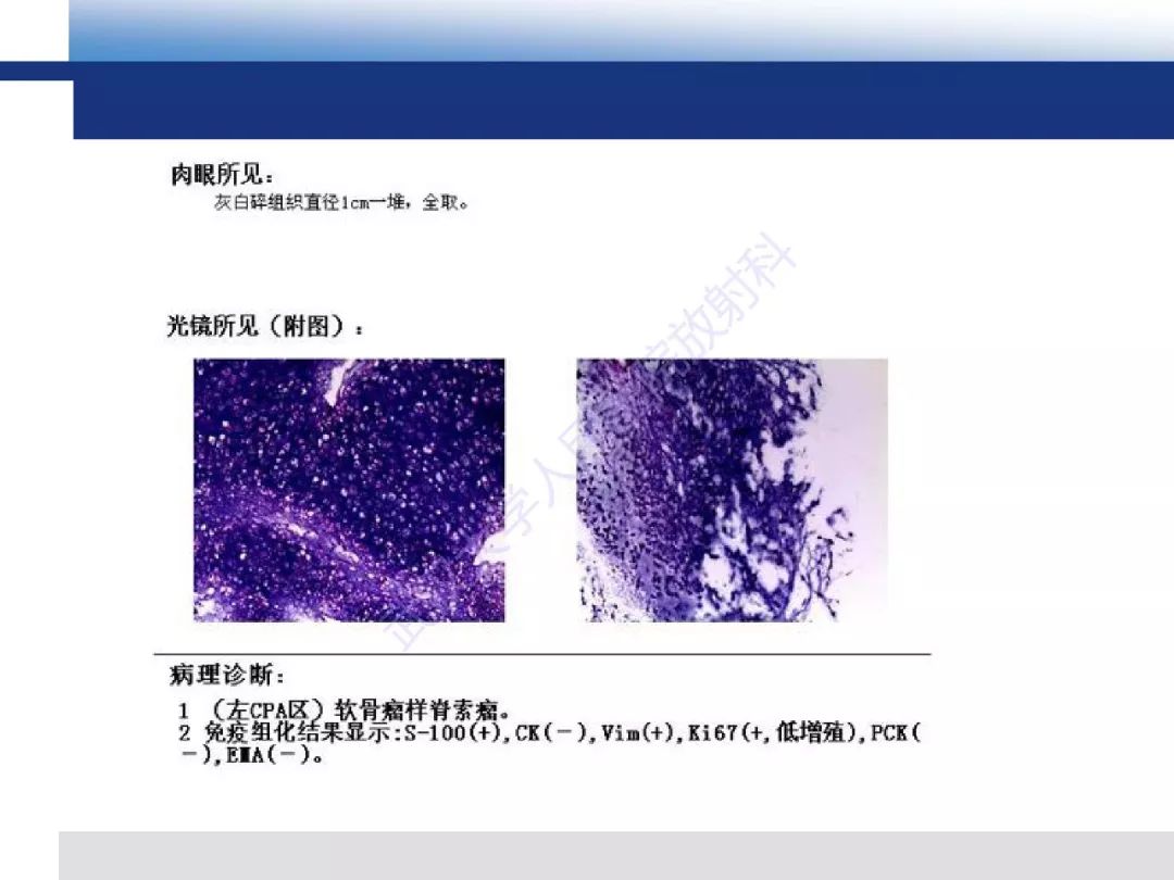 【PPT】颅底软骨样脊索瘤影像诊断