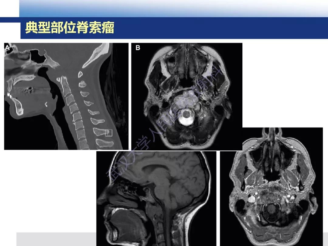 【PPT】颅底软骨样脊索瘤影像诊断