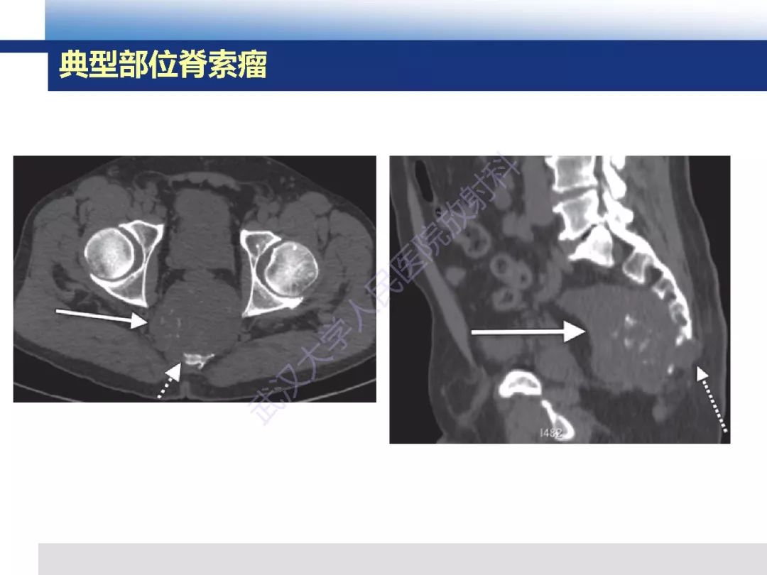 【PPT】颅底软骨样脊索瘤影像诊断