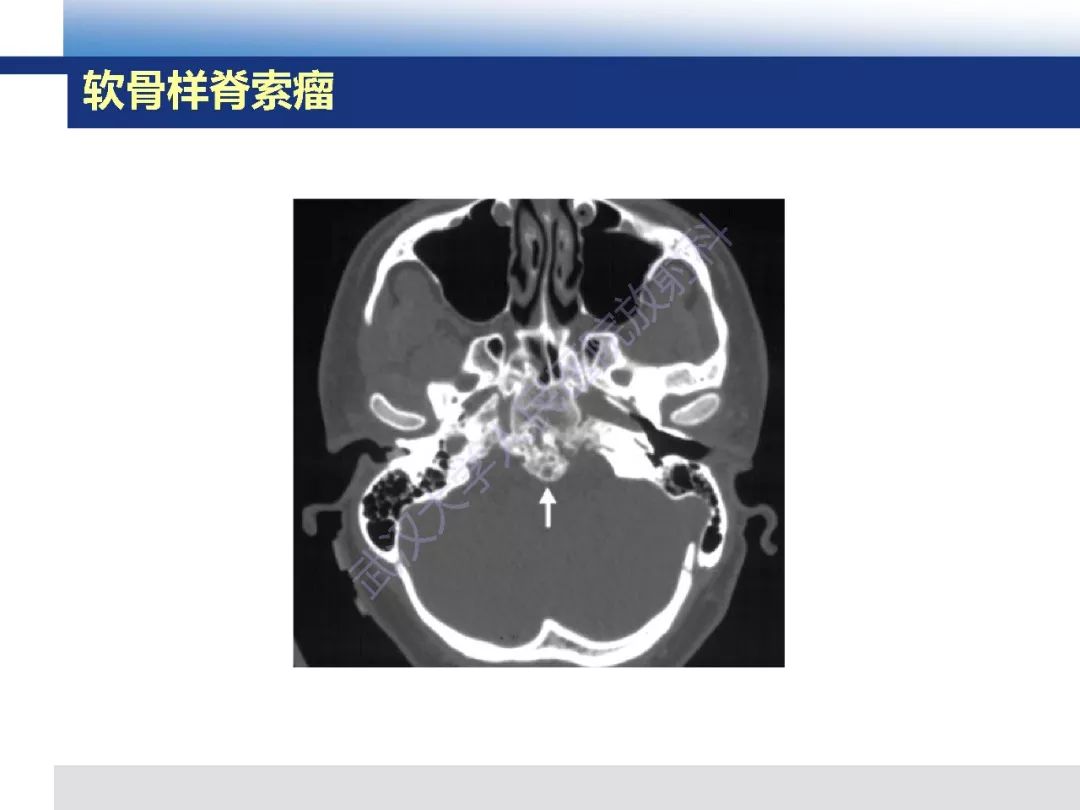 【PPT】颅底软骨样脊索瘤影像诊断