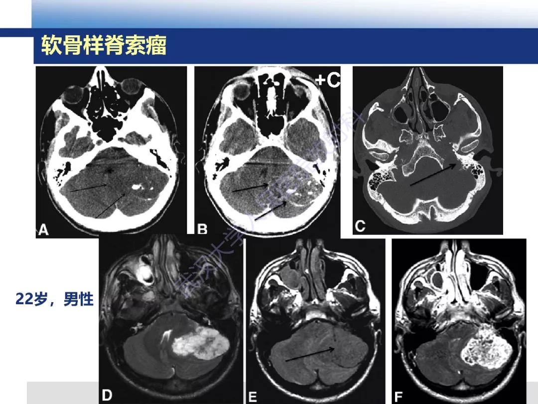 【PPT】颅底软骨样脊索瘤影像诊断