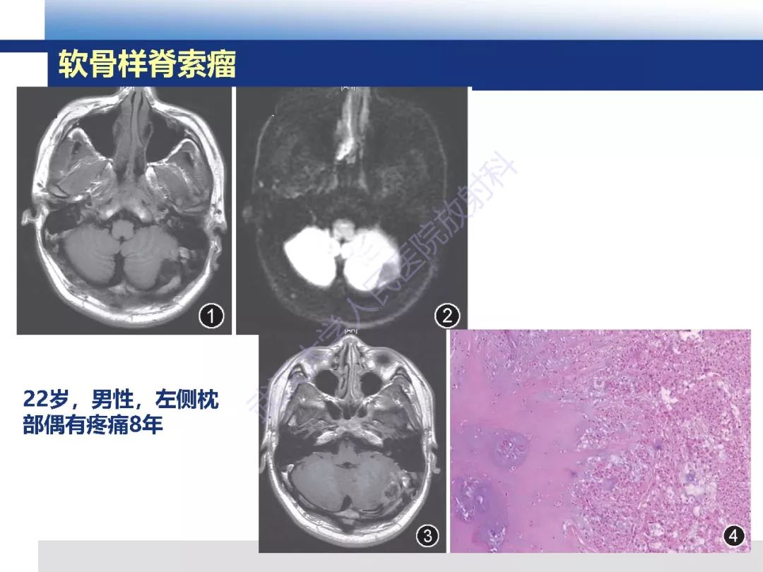 【PPT】颅底软骨样脊索瘤影像诊断