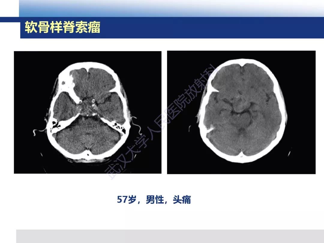 【PPT】颅底软骨样脊索瘤影像诊断