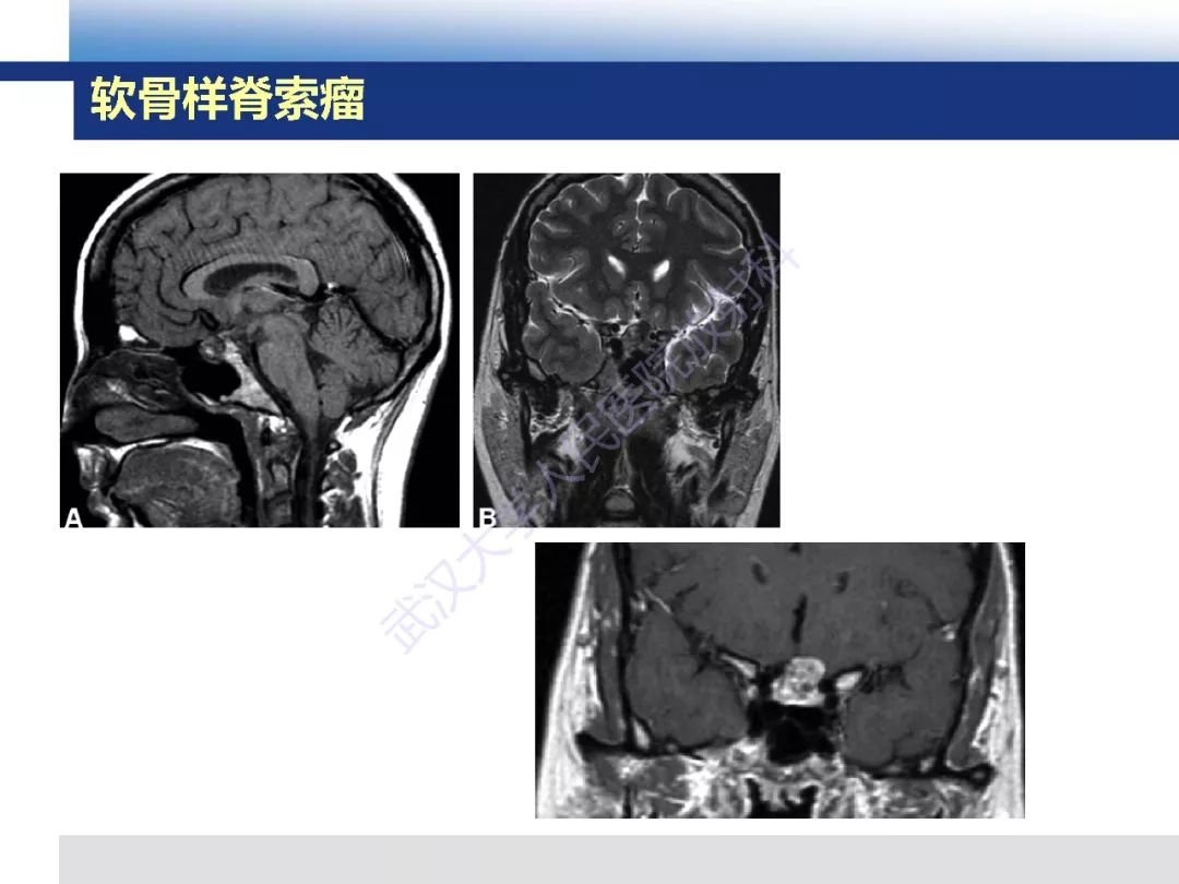 【PPT】颅底软骨样脊索瘤影像诊断