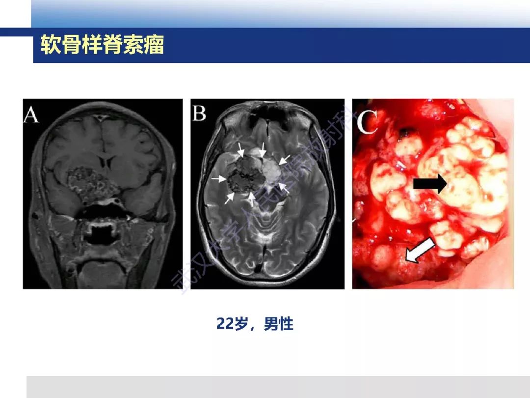 【PPT】颅底软骨样脊索瘤影像诊断