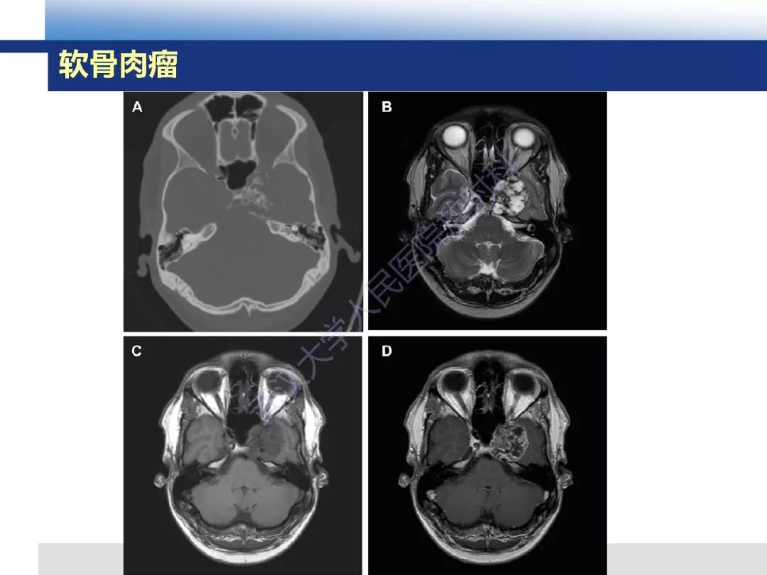 【PPT】颅底软骨样脊索瘤影像诊断