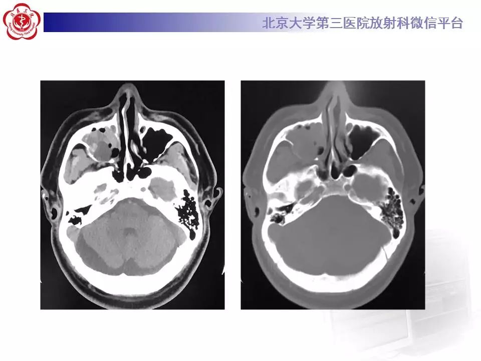 【病例】上颌骨成釉细胞瘤1例CT影像表现