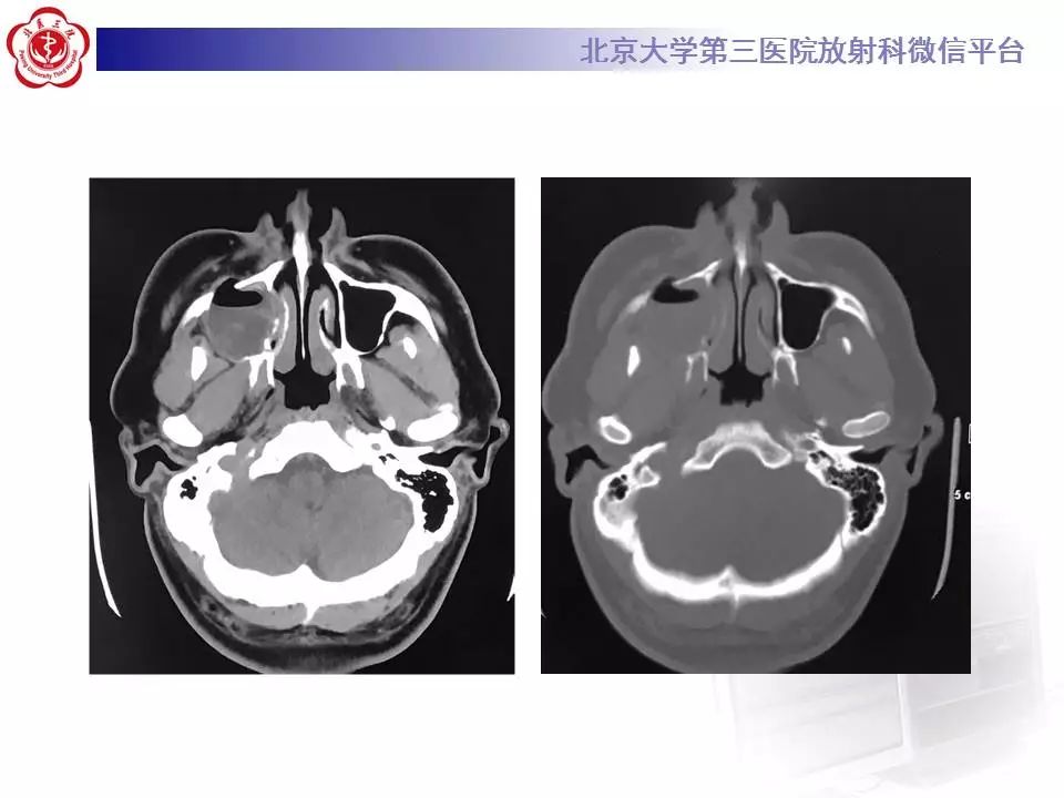 【病例】上颌骨成釉细胞瘤1例CT影像表现