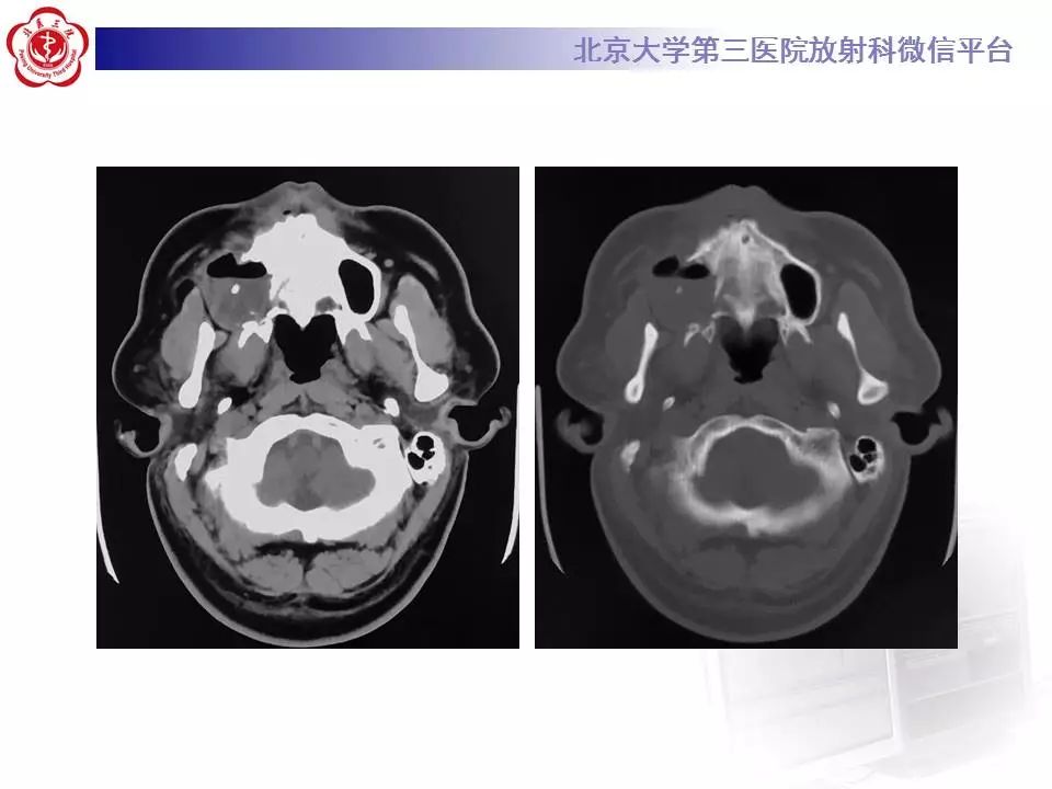 【病例】上颌骨成釉细胞瘤1例CT影像表现