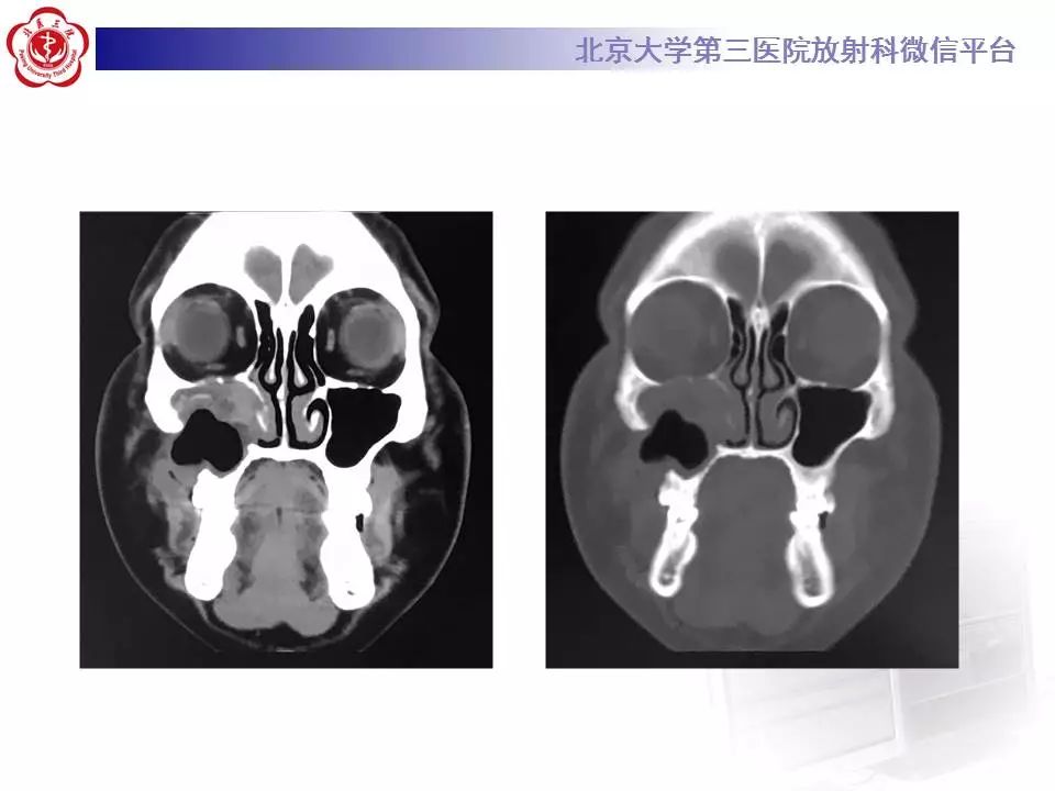 【病例】上颌骨成釉细胞瘤1例CT影像表现