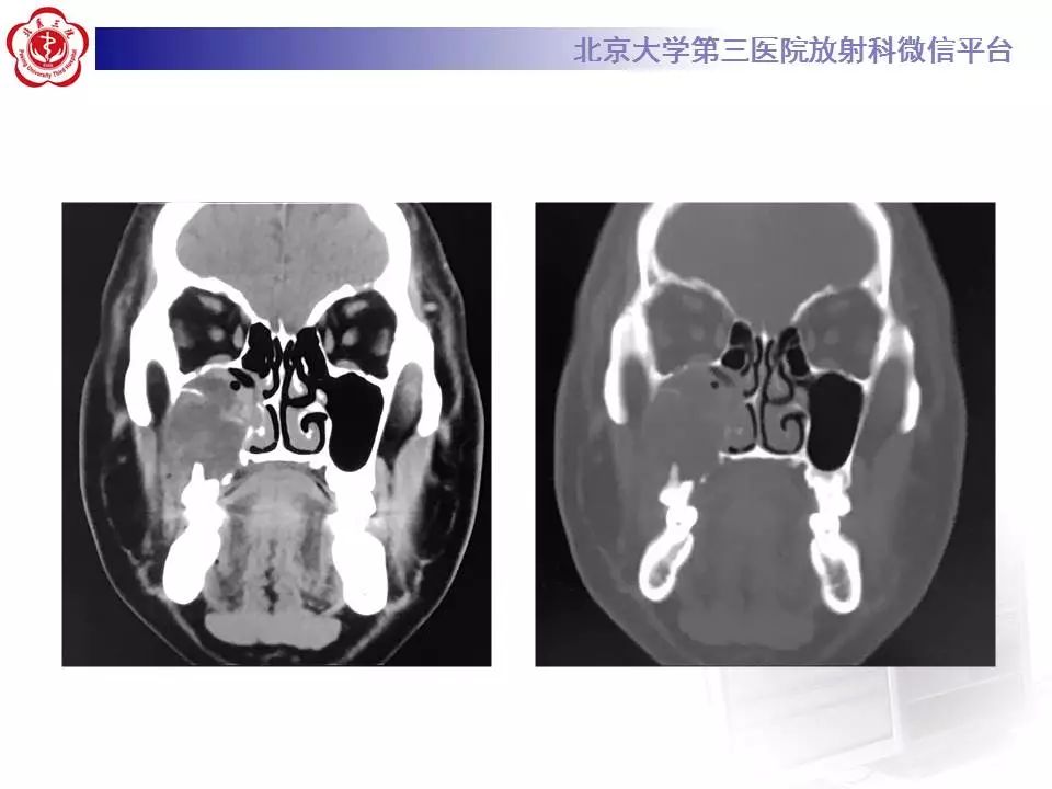 【病例】上颌骨成釉细胞瘤1例CT影像表现
