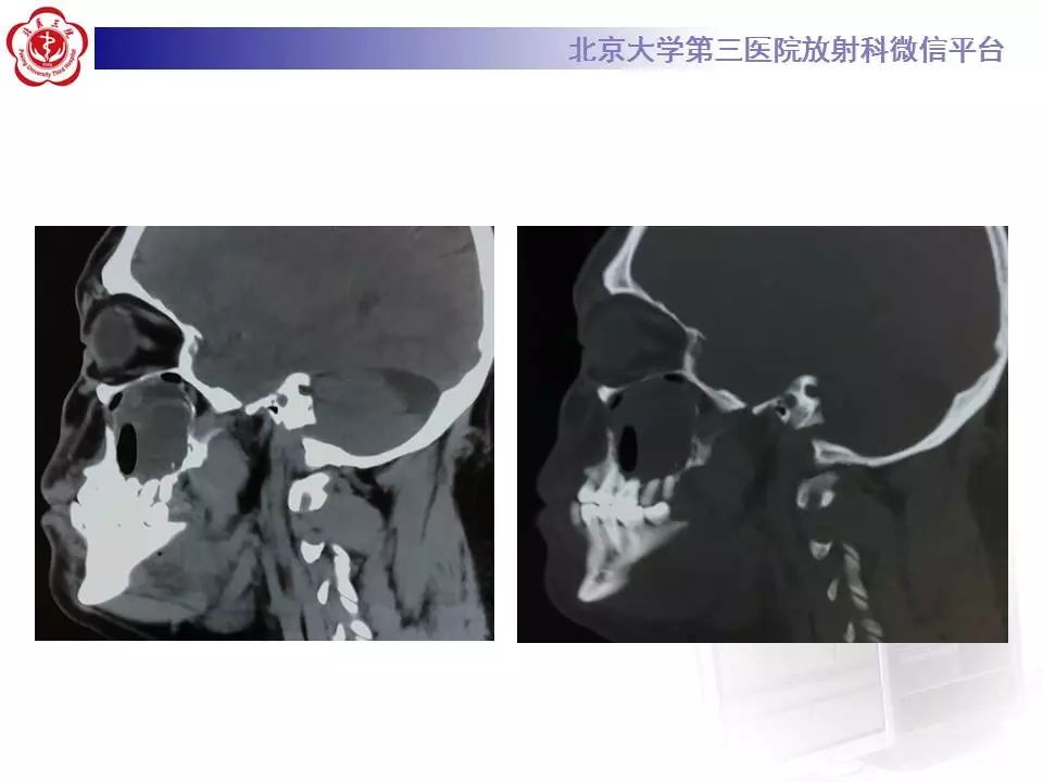 【病例】上颌骨成釉细胞瘤1例CT影像表现
