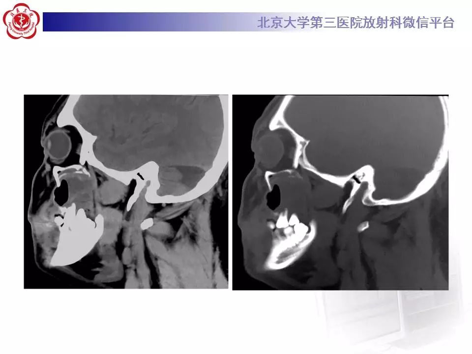 【病例】上颌骨成釉细胞瘤1例CT影像表现