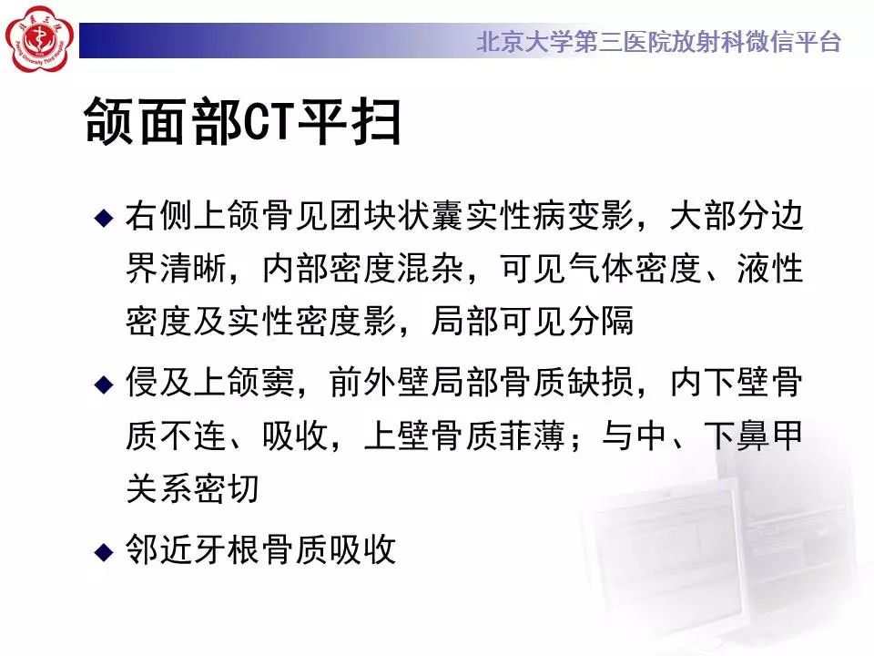 【病例】上颌骨成釉细胞瘤1例CT影像表现