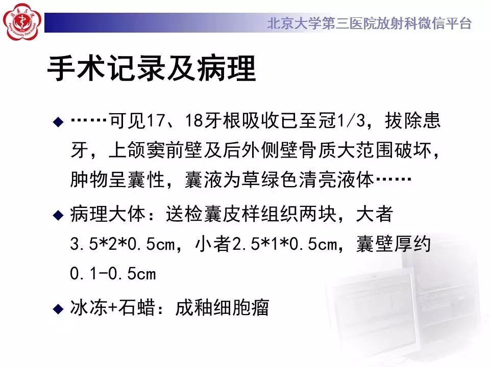 【病例】上颌骨成釉细胞瘤1例CT影像表现