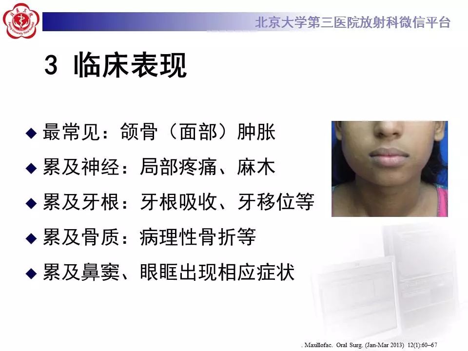 【病例】上颌骨成釉细胞瘤1例CT影像表现