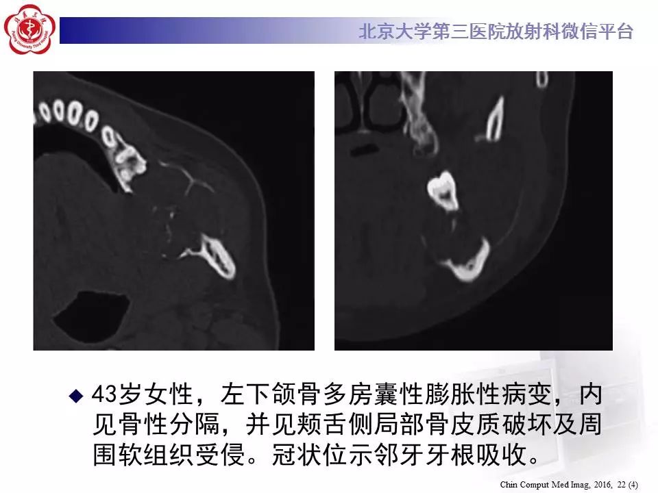 【病例】上颌骨成釉细胞瘤1例CT影像表现