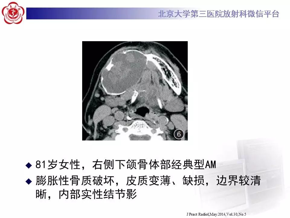 【病例】上颌骨成釉细胞瘤1例CT影像表现