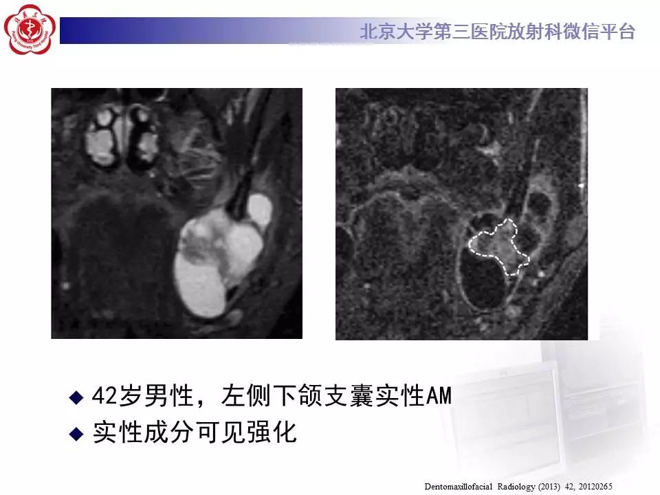 【病例】上颌骨成釉细胞瘤1例CT影像表现