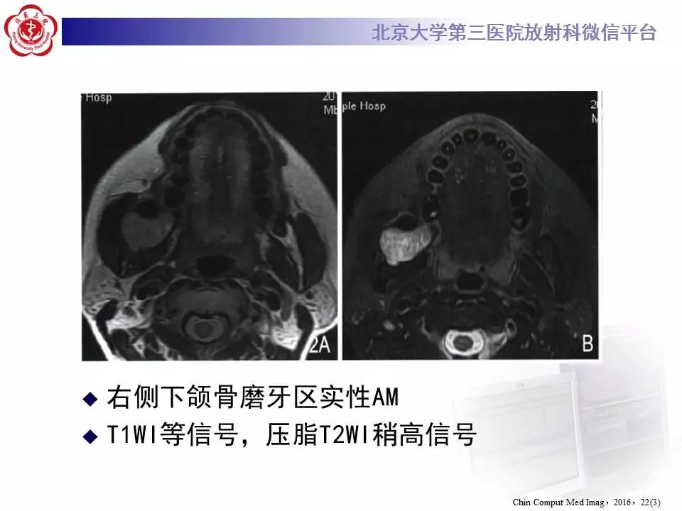 【病例】上颌骨成釉细胞瘤1例CT影像表现
