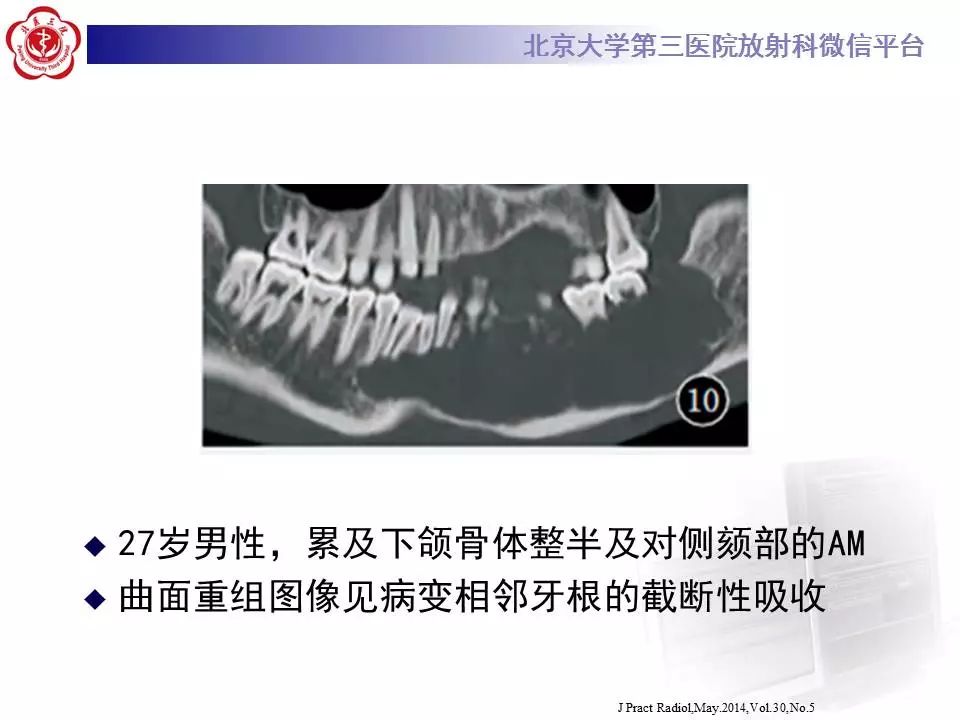 【病例】上颌骨成釉细胞瘤1例CT影像表现