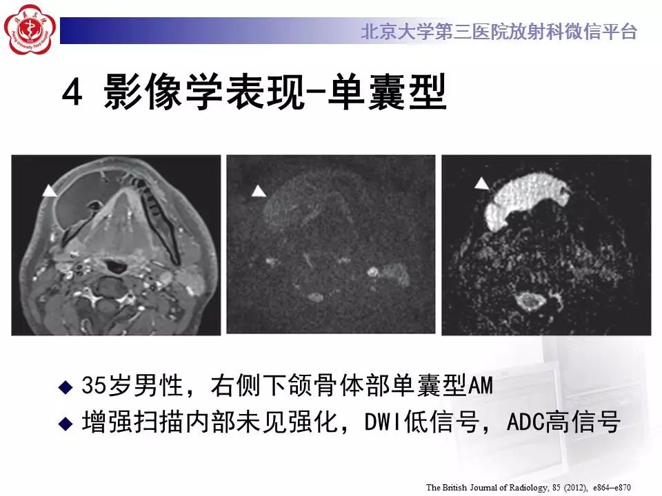 【病例】上颌骨成釉细胞瘤1例CT影像表现