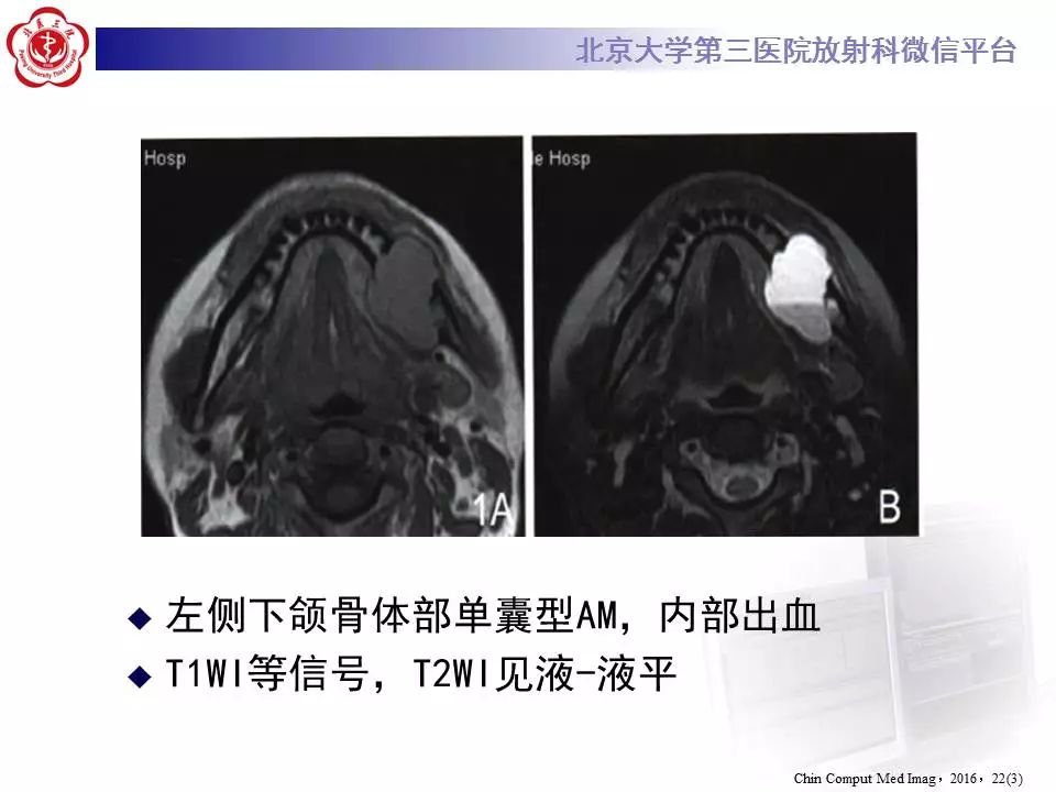 【病例】上颌骨成釉细胞瘤1例CT影像表现