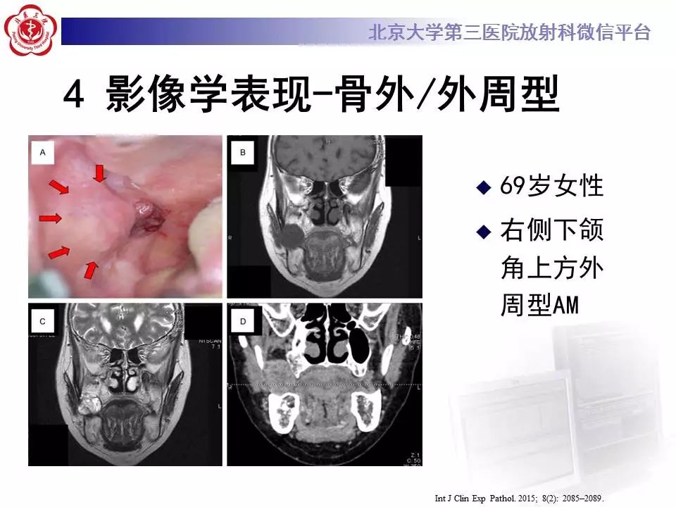 【病例】上颌骨成釉细胞瘤1例CT影像表现