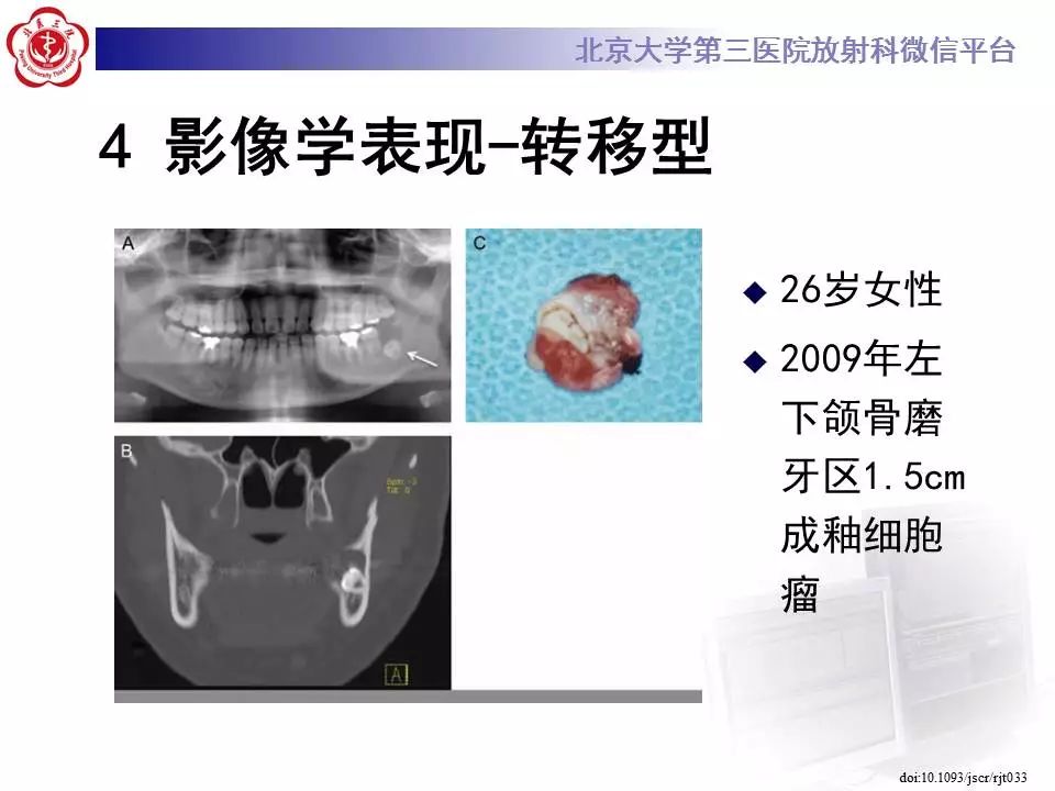 【病例】上颌骨成釉细胞瘤1例CT影像表现