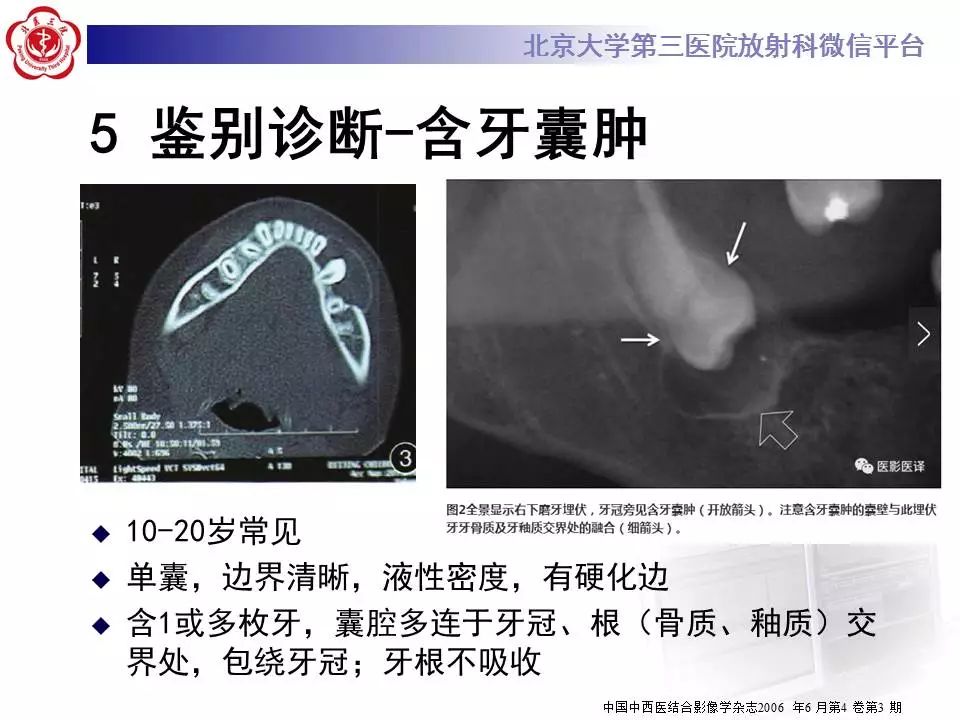 【病例】上颌骨成釉细胞瘤1例CT影像表现