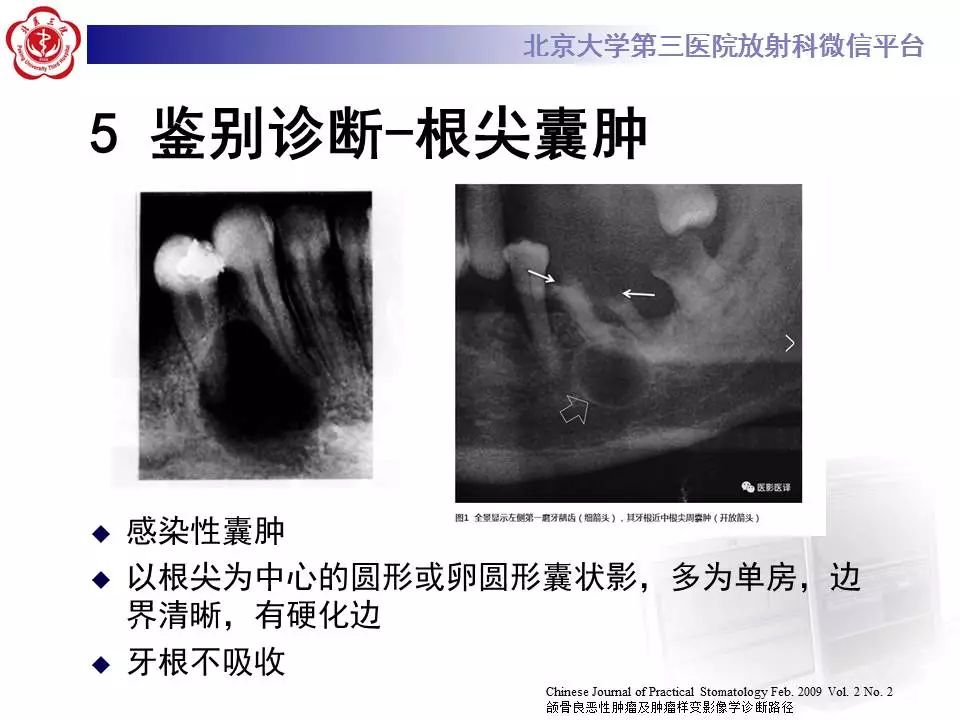 【病例】上颌骨成釉细胞瘤1例CT影像表现