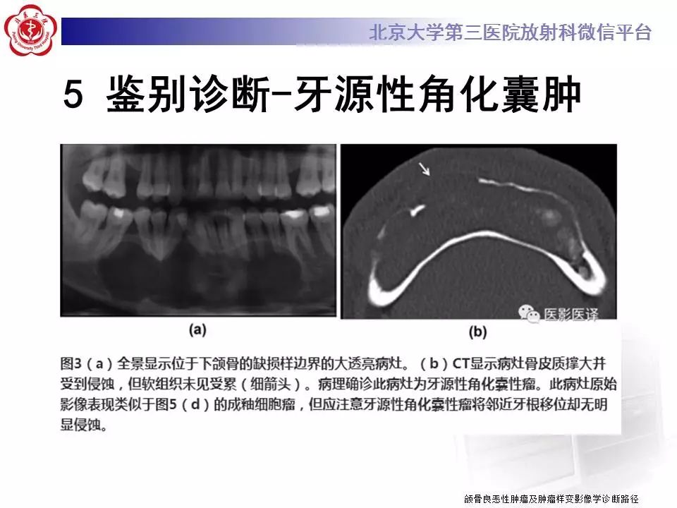 【病例】上颌骨成釉细胞瘤1例CT影像表现