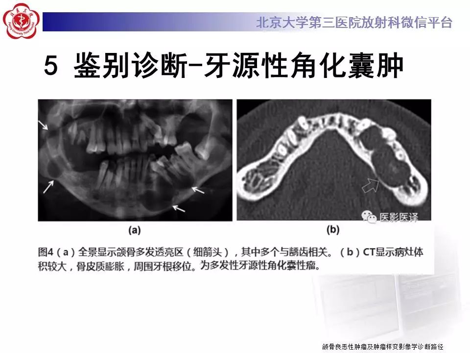 【病例】上颌骨成釉细胞瘤1例CT影像表现