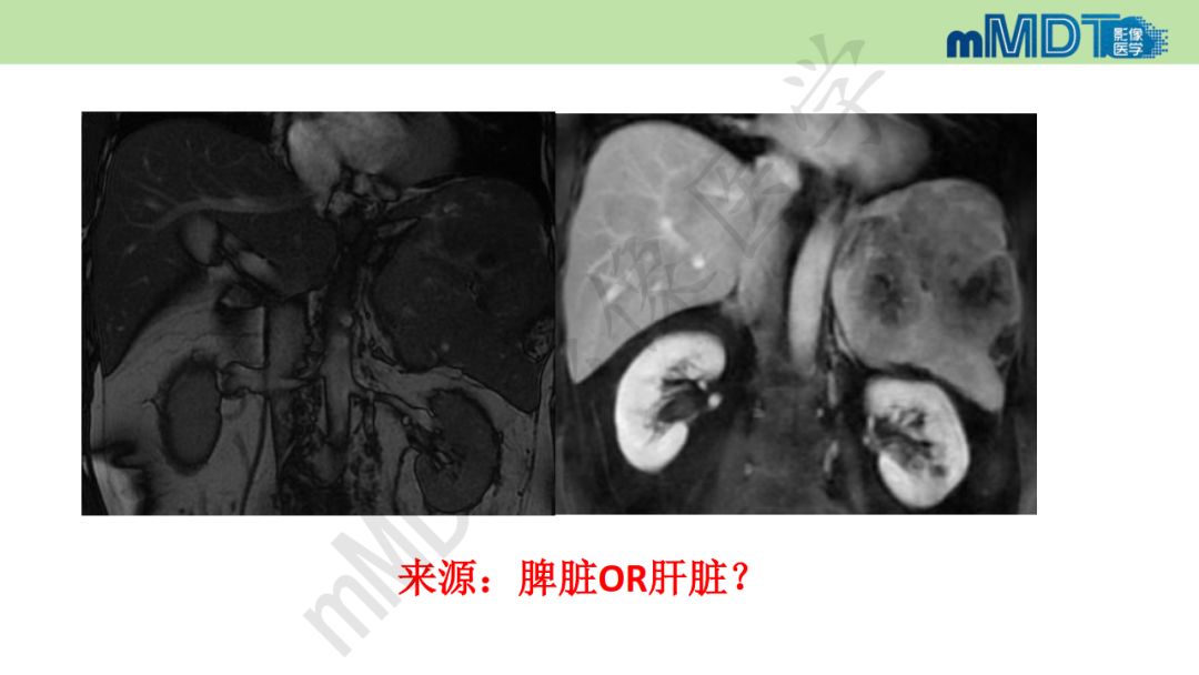 【PPT】特殊类型的肝细胞癌