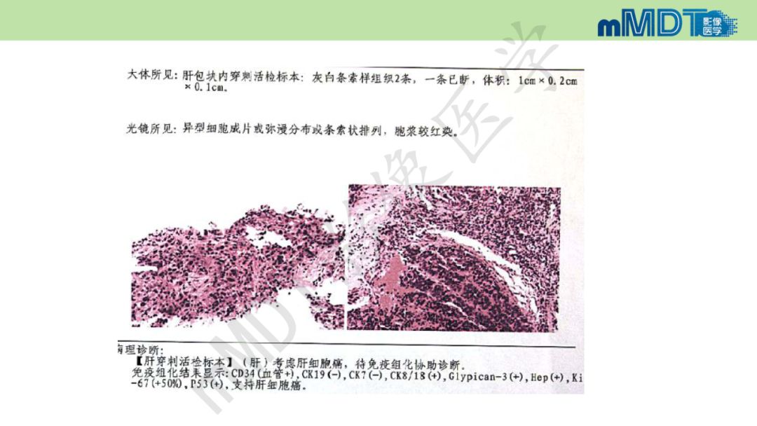 【PPT】特殊类型的肝细胞癌