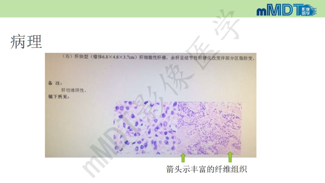 【PPT】特殊类型的肝细胞癌
