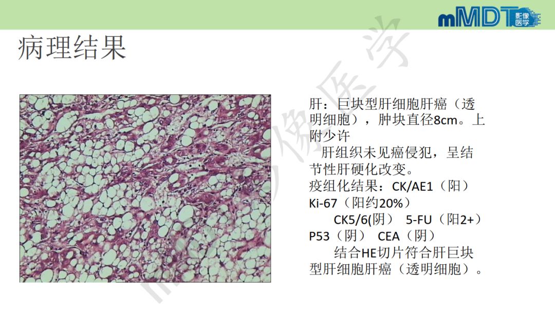 【PPT】特殊类型的肝细胞癌