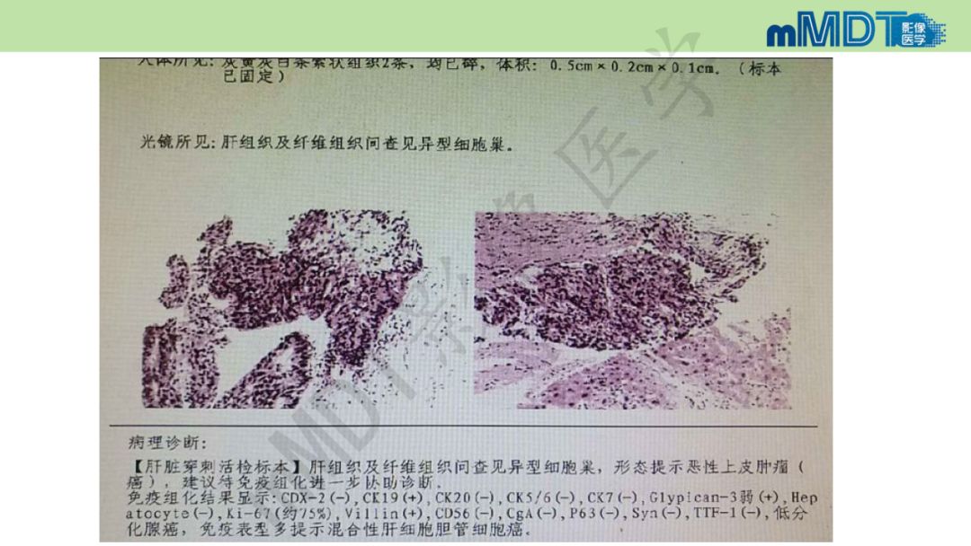 【PPT】特殊类型的肝细胞癌