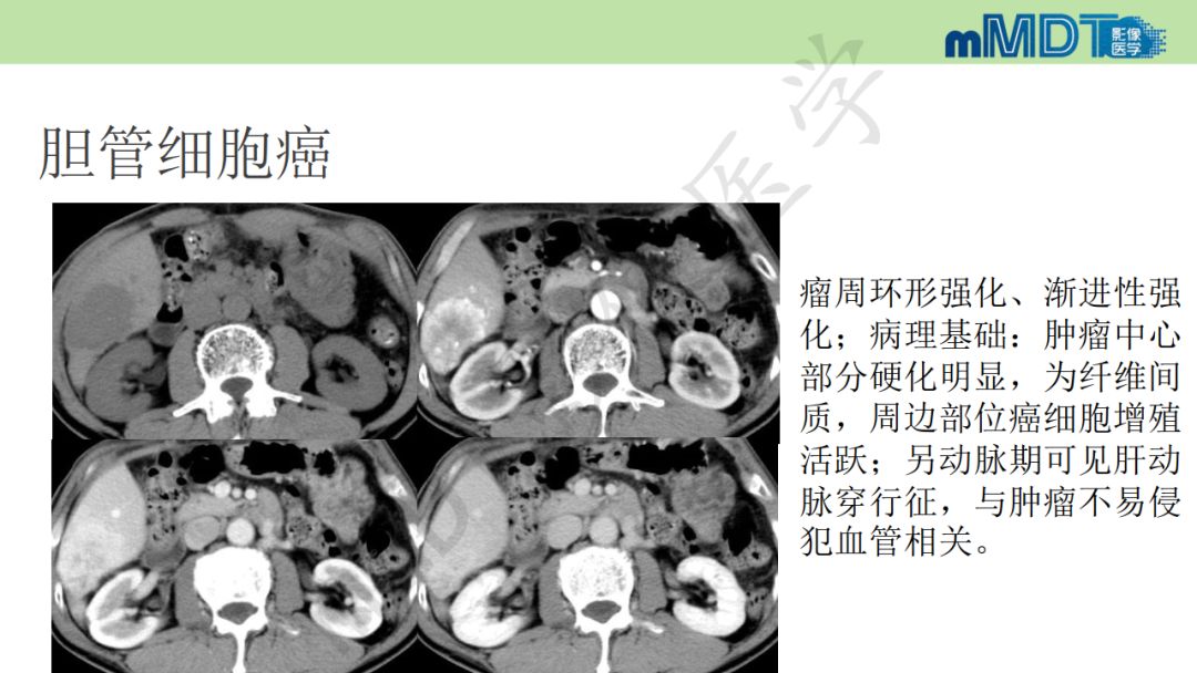 【PPT】特殊类型的肝细胞癌