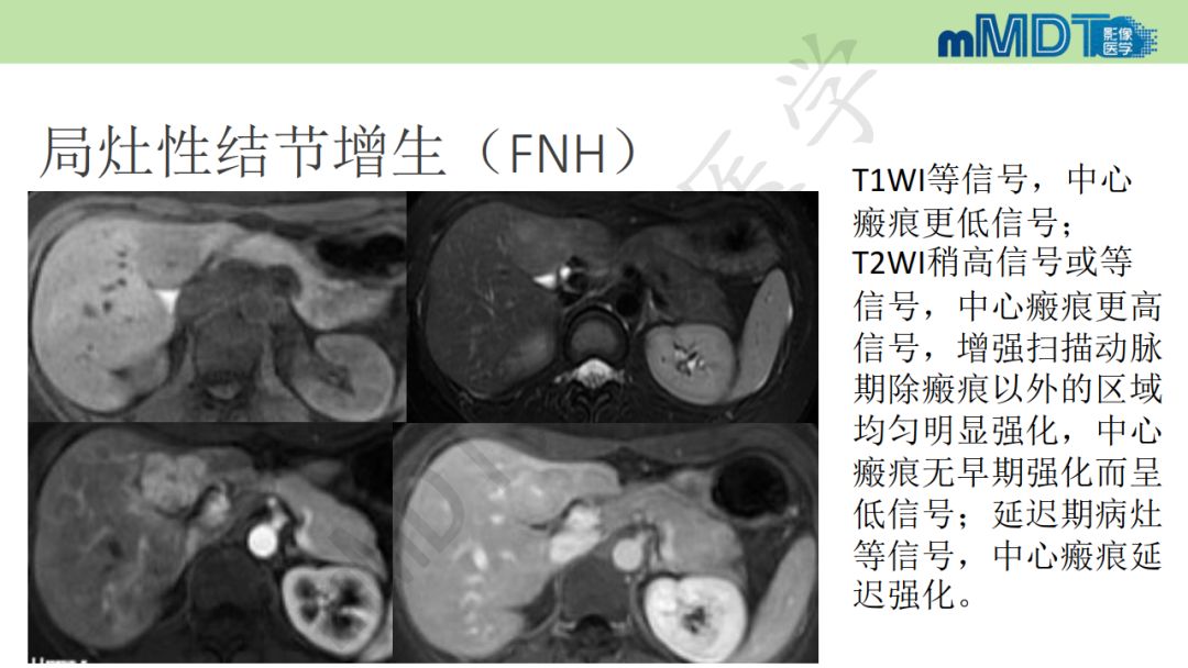 【PPT】特殊类型的肝细胞癌