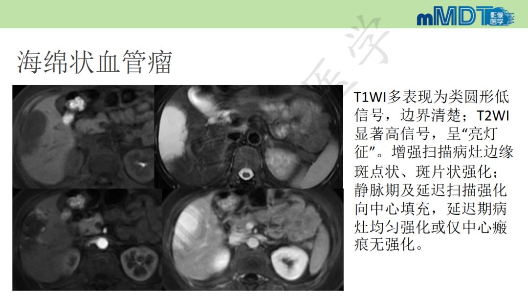 【PPT】特殊类型的肝细胞癌