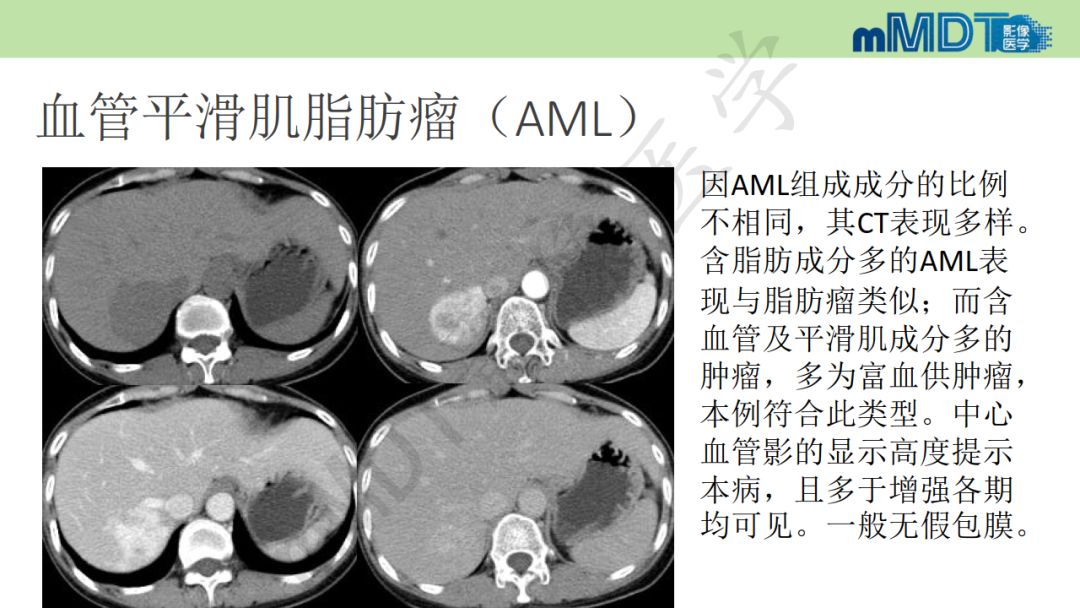 【PPT】特殊类型的肝细胞癌