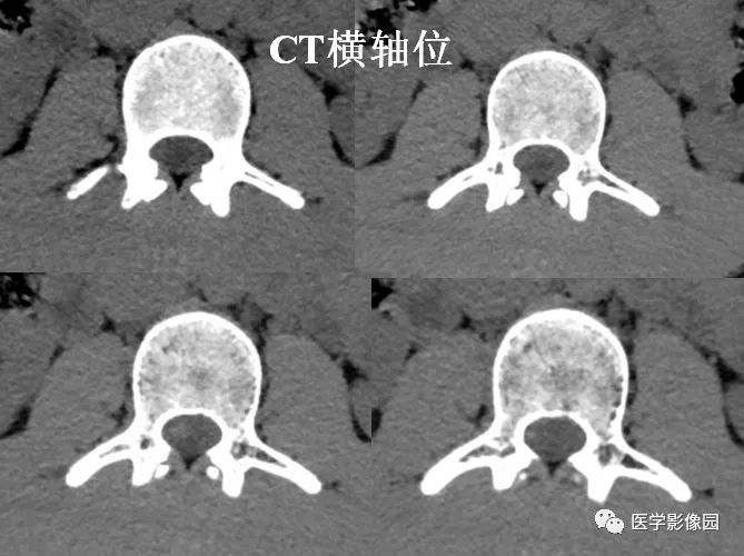 【病例】椎管内囊性占位—皮样囊肿1例MR影像表现