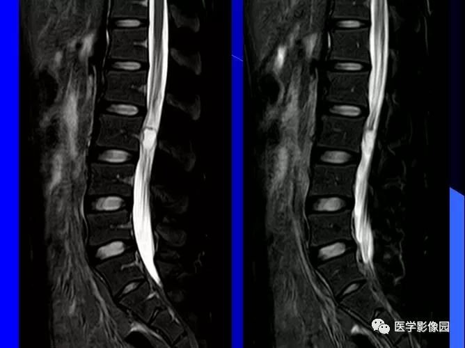 【病例】椎管内囊性占位—皮样囊肿1例MR影像表现