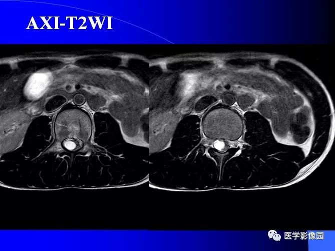 【病例】椎管内囊性占位—皮样囊肿1例MR影像表现