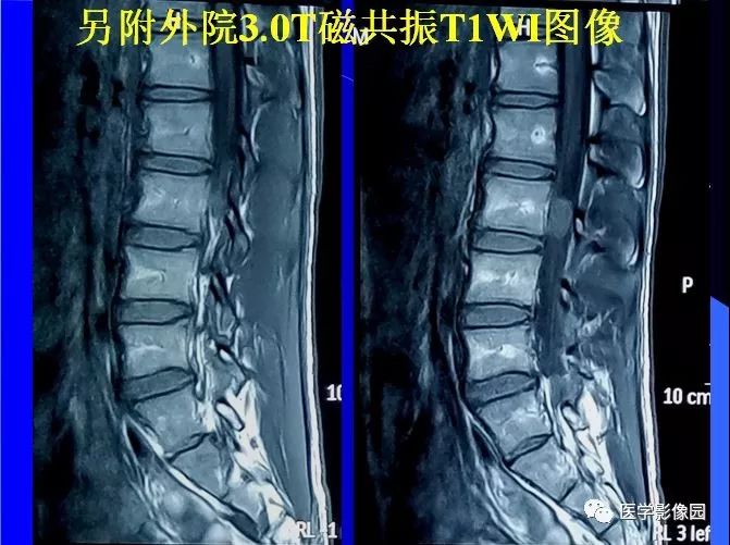 【病例】椎管内囊性占位—皮样囊肿1例MR影像表现